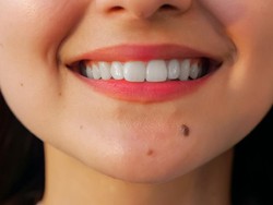 Asal Usul Munculnya Tahi Lalat di Tubuh