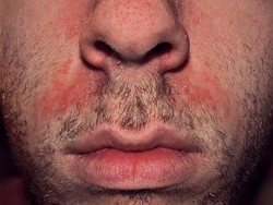 Apa Itu Dermatitis Seboroik? Kenali Gejala, Penyebab, dan Pengobatannya