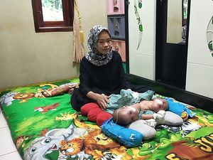 Tolong! Bayi Kembar Siam di Lebak Butuh Bantuan untuk Operasi