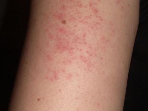 Apa Itu Keratosis Pilaris Pada Kulit? Ketahui Penyebab dan Cara Mengobatinya