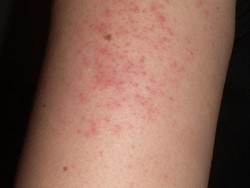 Apa Itu Keratosis Pilaris Pada Kulit? Ketahui Penyebab dan Cara Mengobatinya