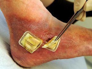 Terapi Belatung Ampuh Mengobati Luka dan Borok Kronis