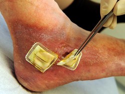 Terapi Belatung Ampuh Mengobati Luka dan Borok Kronis