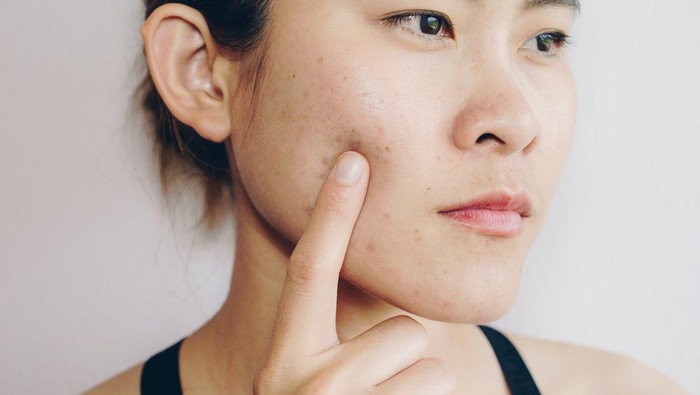 1063965962 Problems with acne and scar on the female skin.