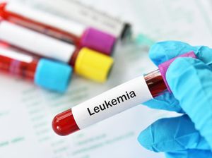 6 Gejala Leukemia Stadium Awal, Kerap Tak Disadari 6 Gejala Leukemia Stadium Awal, Kerap Tak Disadari