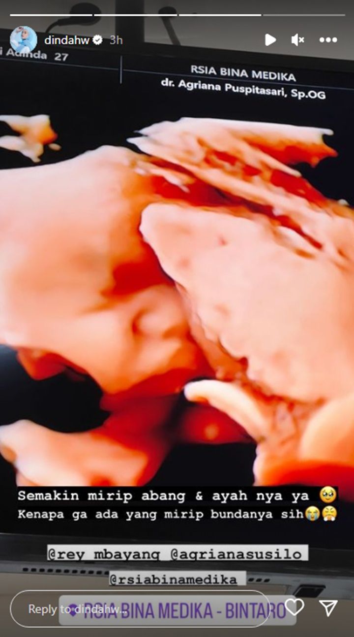 Potret hasil USG anak kedua Dinda Hauw dan Rey Mbayang