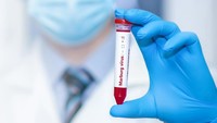 Wanti-wanti WHO soal Angka Kematian Virus Marburg 90 Persen-Risiko Menyebar ke RI