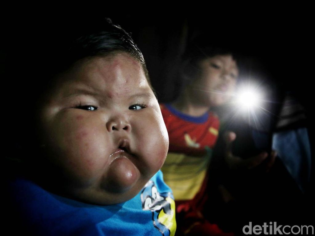 Kemenkes: Kasus Bayi Obesitas Kenzie Langka, Diduga Kelainan Genetik Kemenkes: Kasus Bayi Obesitas Kenzie Langka, Diduga Kelainan Genetik