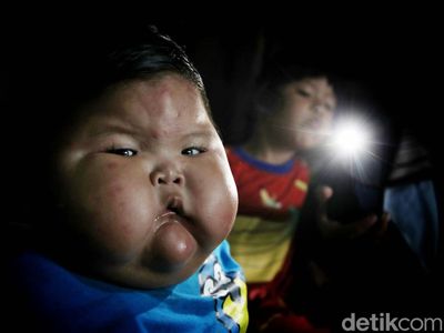 Potret Kenzie Si Bayi Viral Obesitas di Bekasi, Umur Setahun Beratnya 27 Kg