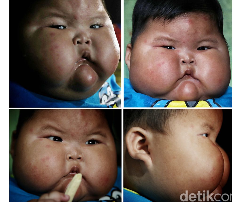 Viral bayi bernama Kenzie, punya bobot 27 kilogram di usia satu tahun. Ibunda Kenzie, Pitriah mengungkapkan berat badan anaknya memang berlebih sejak ia lahir.Akibat obesitas yang dialaminya, tumbuh kembang Kenzie terganggu. Tidak seperti bayi seusianya, Kenzie belum bisa berdiri tegak.