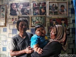 Kondisi Bayi Obesitas 27 Kg di Bekasi yang Tak Sempat Diberi ASI Kondisi Bayi Obesitas 27 Kg di Bekasi yang Tak Sempat Diberi ASI