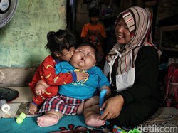 Bayi Obesitas di Bekasi Punya BB 27 Kg Akan Jalani Pemeriksaan Hormon