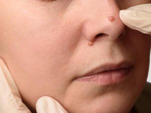 Apa Itu Papiloma? Ketahui Penyebab dan Cara Menghilangkannya