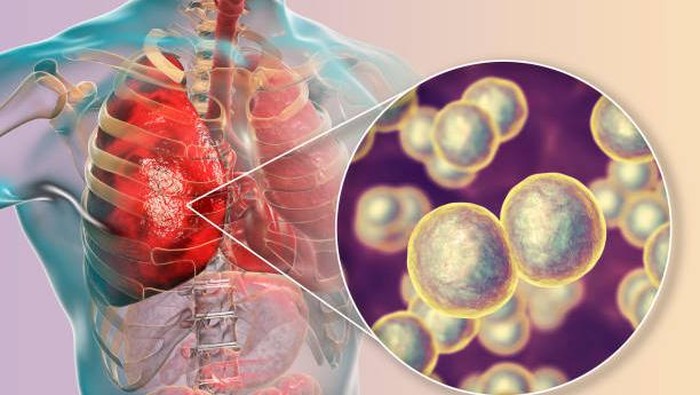 ilustrasi pneumonia yang disebabkan oleh bakteri pneumonia