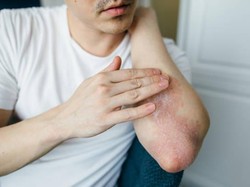 5 Jenis Jamur Kulit, Ketahui Penyebab dan Cara Mengatasinya