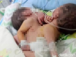 Bayi Kembar Siam Dempet Dada Lahir di Medan, Begini Kondisinya