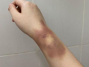 Jadi Korban KDRT, Lengan Sepupu Calon Istri Fritz Hutapea Alami Lebam Jadi Korban KDRT, Lengan Sepupu Calon Istri Fritz Hutapea Alami Lebam