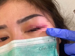 Derita Sepupu Calon Istri Fritz Hutapea Lengan-Pelipis Lebam akibat KDRT