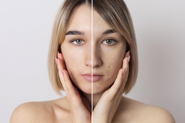 Skincare yang baik dapat membantu mengatasi permasalahan kulit, seperti jerawat