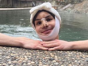 9 Foto Transgender Jalani Operasi Feminisasi Wajah, Begini Hasilnya