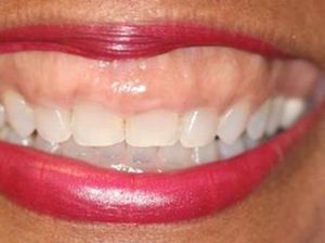 Gummy Smile atau Senyum Gusi, Kenali Penyebab dan Cara Mengatasinya