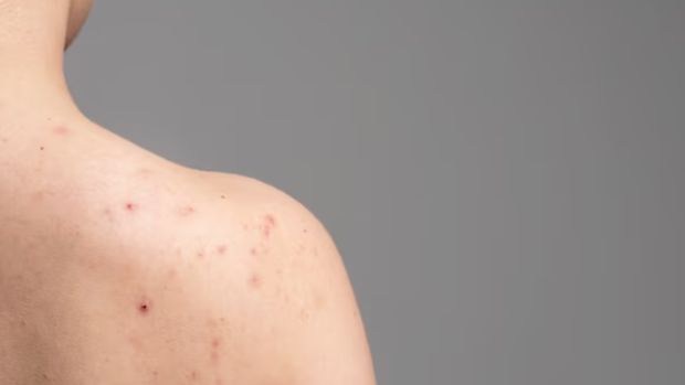 Ilustrasi jerawat punggung /Foto: freepik.com