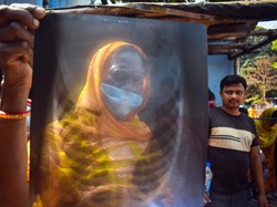 India Catat Lonjakan Infeksi Adenovirus, 12 Warga Meninggal! Ini Pemicunya