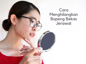 10 Cara Menghilangkan Bekas Jerawat yang Menghitam