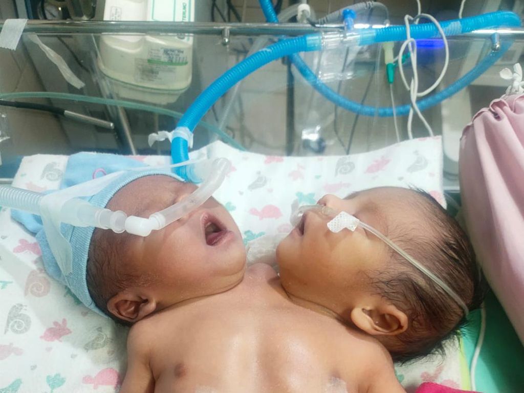 Bayi Kembar Siam dengan Satu Jantung Lahir di Jaktim, Butuh Ruang NICU