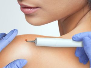 Cara Menghilangkan Kutil Secara Alami dan Medis dengan Cepat