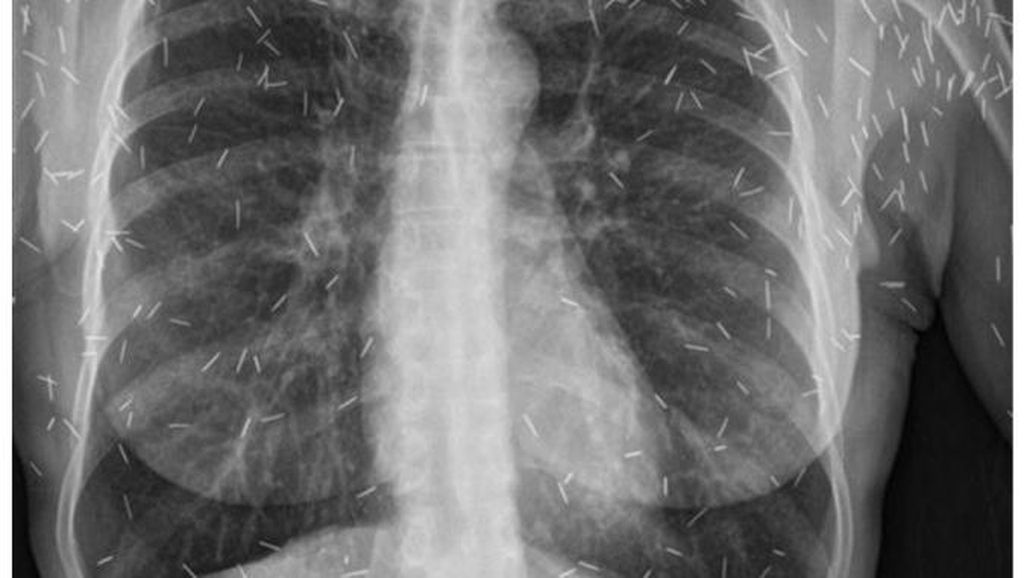 5 Foto X-ray Bikin Merinding, Barbel Nyangkut di Anus sampai Penampakan Susuk