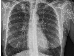 5 Foto X-ray Bikin Merinding, Barbel Nyangkut di Anus sampai Penampakan Susuk