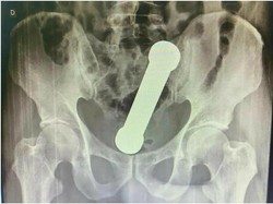 Bikin Ngilu, Barbel 2 Kg Nyangkut di Anus Pria Ini! Kok Bisa?