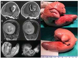 Kasus Langka, Ada Janin di Otak Anak Umur 1 Tahun