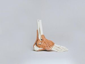 Macam-macam Kelainan Otot pada Manusia yang Sering Terjadi