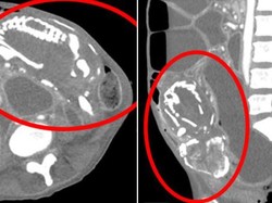 Wanita Meninggal Kekurangan Gizi, Janin 9 Tahun Ditemukan Bersarang di Perut