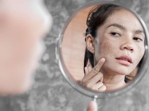 Video: Flek Hitam atau Melasma? Kenali Bedanya!