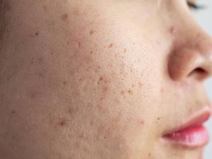 10 Cara Menghilangkan Bopeng Bekas Jerawat dengan Bahan Alami 10 Cara Menghilangkan Bopeng Bekas Jerawat dengan Bahan Alami