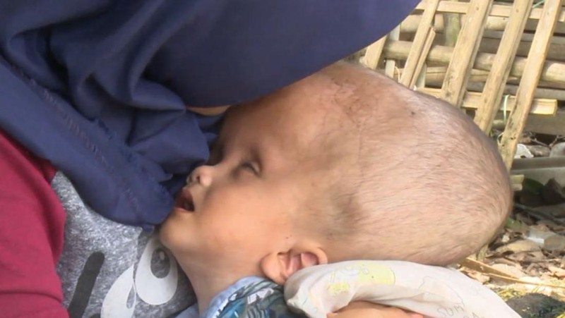 Kisah Sedih Anak Pekerja Serabutan Alami Hidrosefalus, Mari Kita Bantu