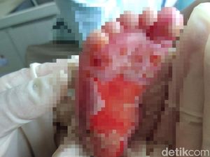Pembelaan RS di Medan Usai Kaki Bayi Melepuh karena Dikompres Perawat Pembelaan RS di Medan Usai Kaki Bayi Melepuh karena Dikompres Perawat