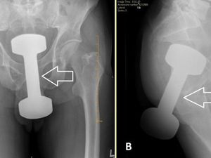 Viral Penampakan X-Ray Dumbell Masuk Dubur, Betulan di Indonesia? Viral Penampakan X-Ray Dumbell Masuk Dubur, Betulan di Indonesia?