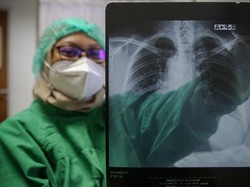 WHO Rilis Data Baru, Kasus TBC di Indonesia Masih Peringkat Ke-2 di Dunia