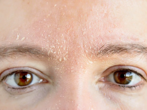 5 tanda-tanda kulit wajah kamu mengalami dehidrasi