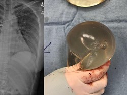 Viral Peluru Nyangkut di Implan Payudara Wanita