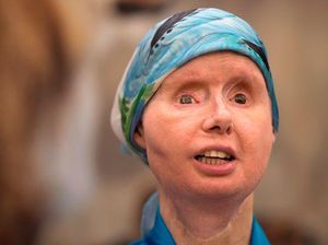 Wanita Diserang Simpanse 16 Tahun Lalu Hingga Buta & Wajah Rusak, Masih Trauma