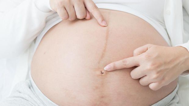 Ilustrasi linea nigra pada ibu hamil