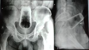 6 Potret X-Ray Mencengangkan, Tunjukkan Benda yang Nyangkut di Tubuh Pasien