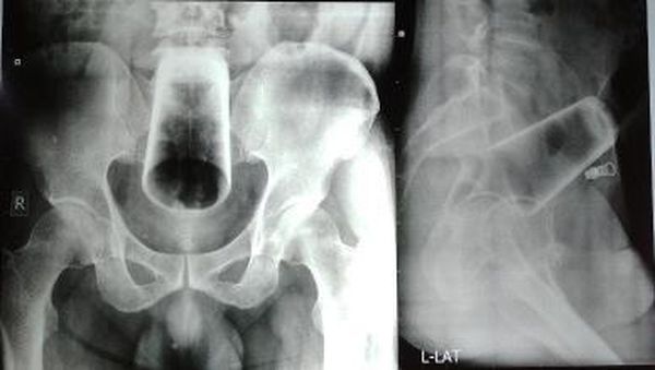 6 Potret X-Ray Mencengangkan, Tunjukkan Benda yang Nyangkut di Tubuh Pasien