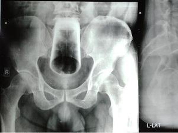 6 Potret X-Ray Mencengangkan, Tunjukkan Benda yang Nyangkut di Tubuh Pasien
