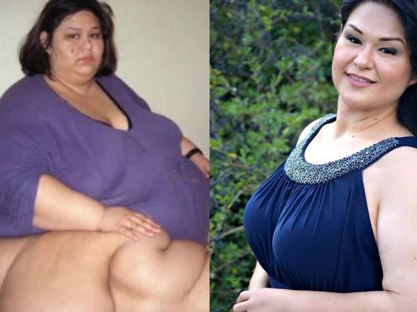 Before-After Wanita Tergemuk di Dunia, Bikin Takjub! Sukses Pangkas 363 Kg
